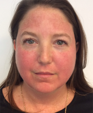Vbeam Before & After Gallery - Patient 108352 - Image 2