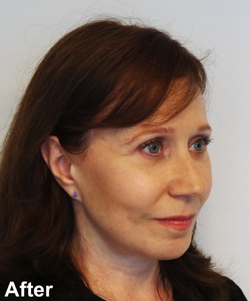 Blepharoplasty Before & After Gallery - Patient 112715 - Image 4
