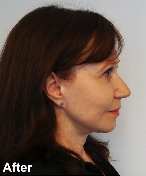 Blepharoplasty Before & After Gallery - Patient 112715 - Image 6