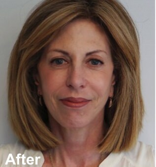 Blepharoplasty Before & After Gallery - Patient 349563 - Image 2