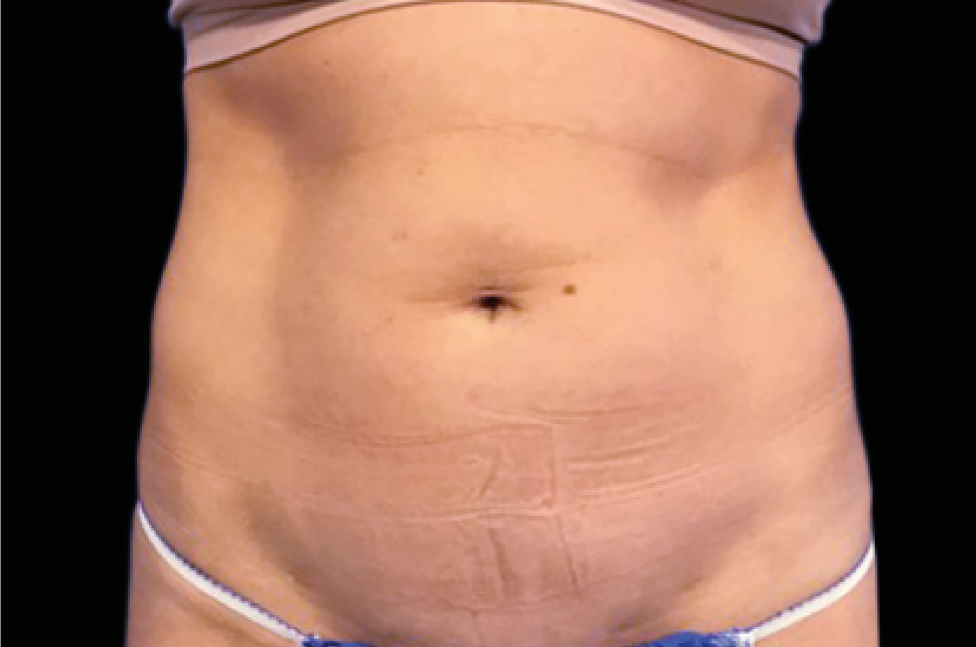 Emsculpt Neo Before & After Gallery - Patient 202078 - Image 1