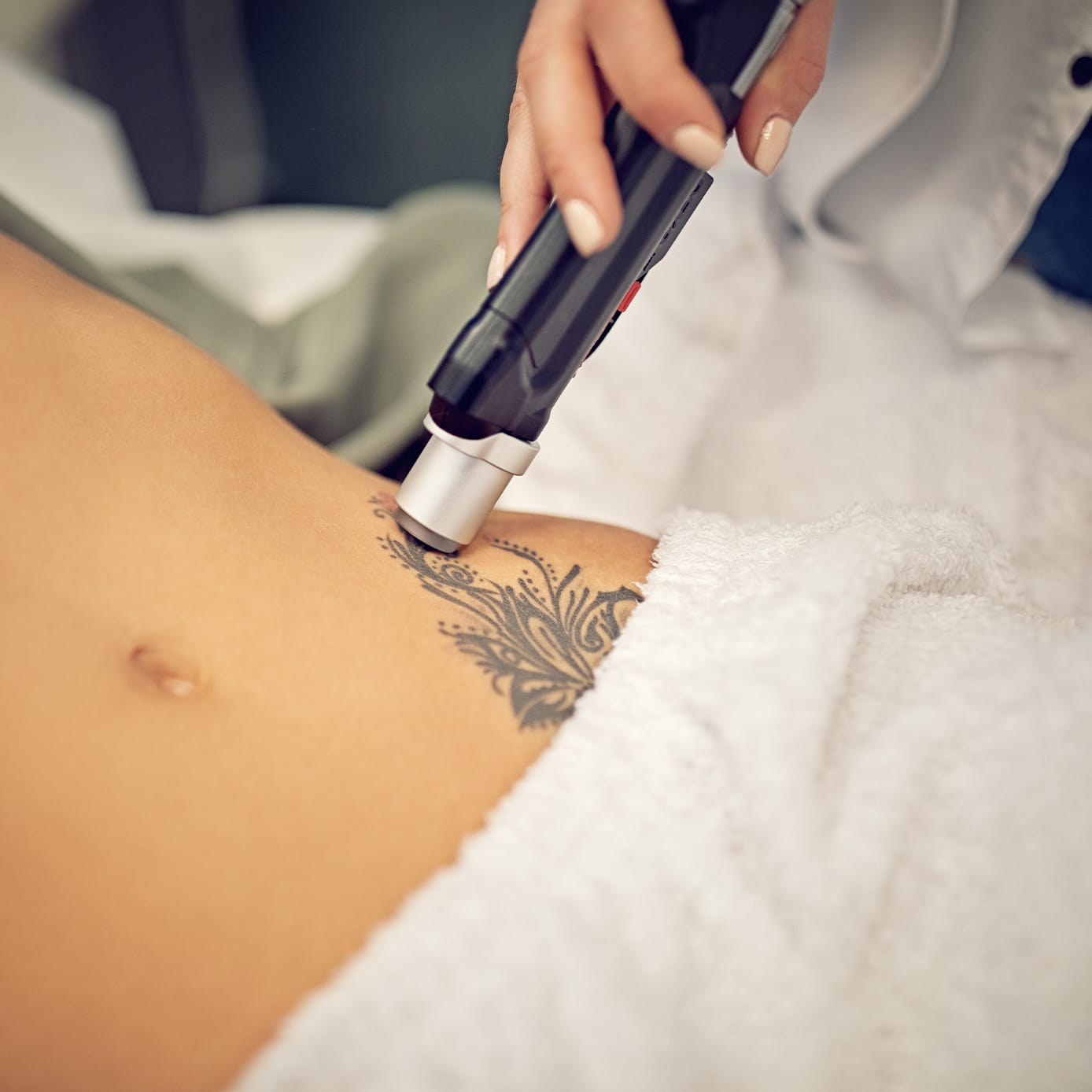 A tattoo being removed