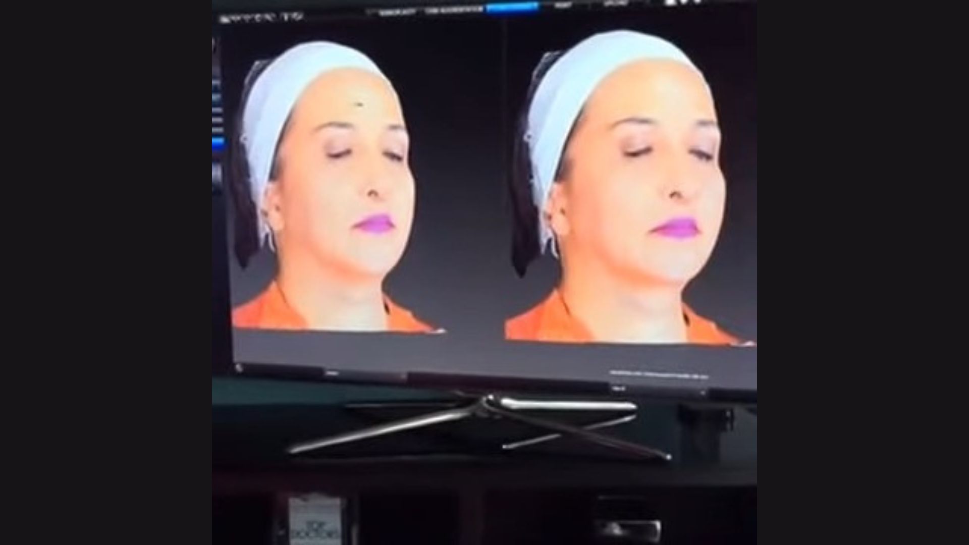 The Kybella Injection Process video