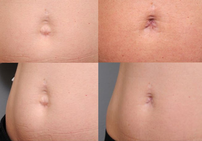 belly buttons