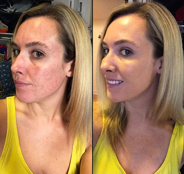 before and after vampire facial