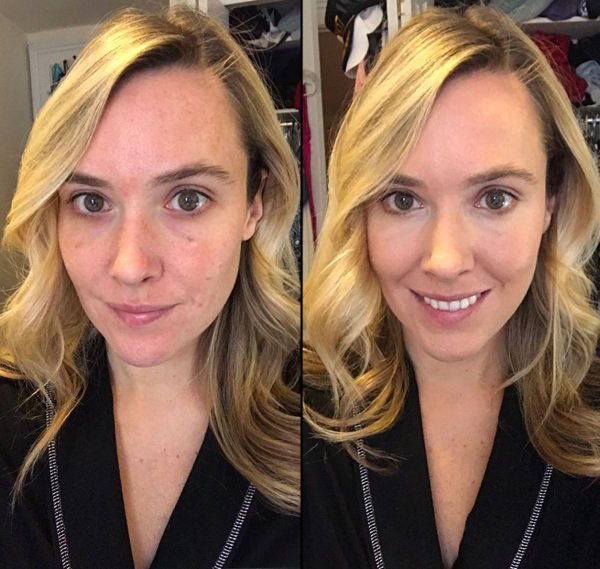 before and after vampire facial